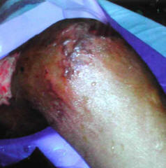 Surgically debrided lesions.